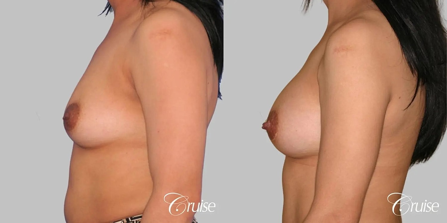 Breast Augmentation Before & After