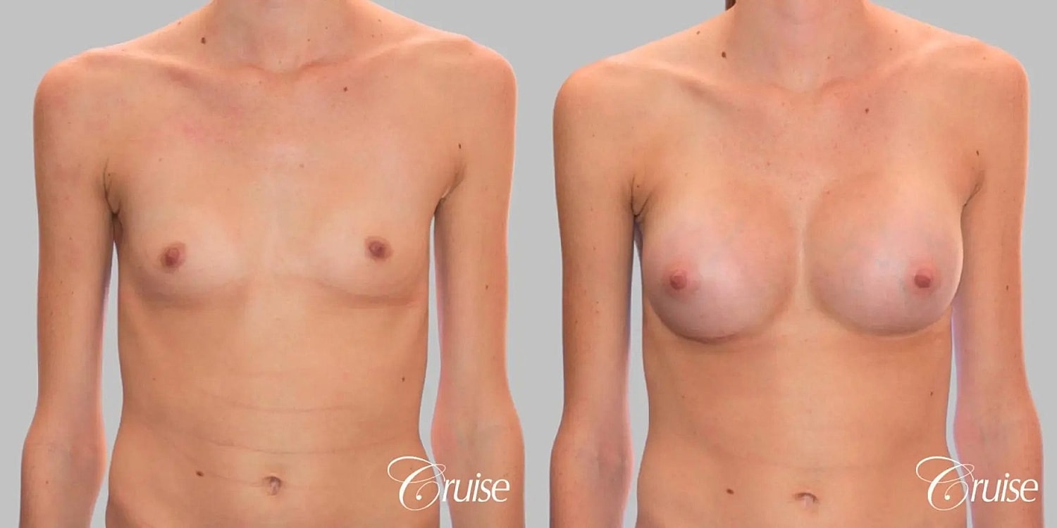 Breast Augmentation Before & After