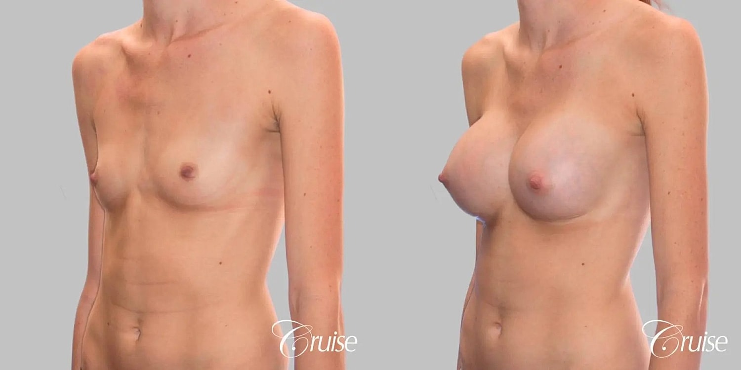 Breast Augmentation Before & After