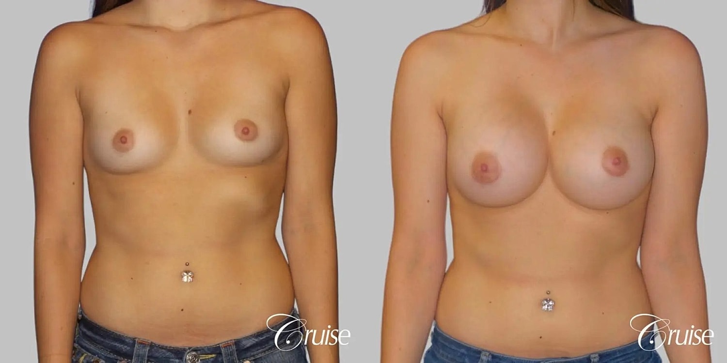 Breast Augmentation Before & After