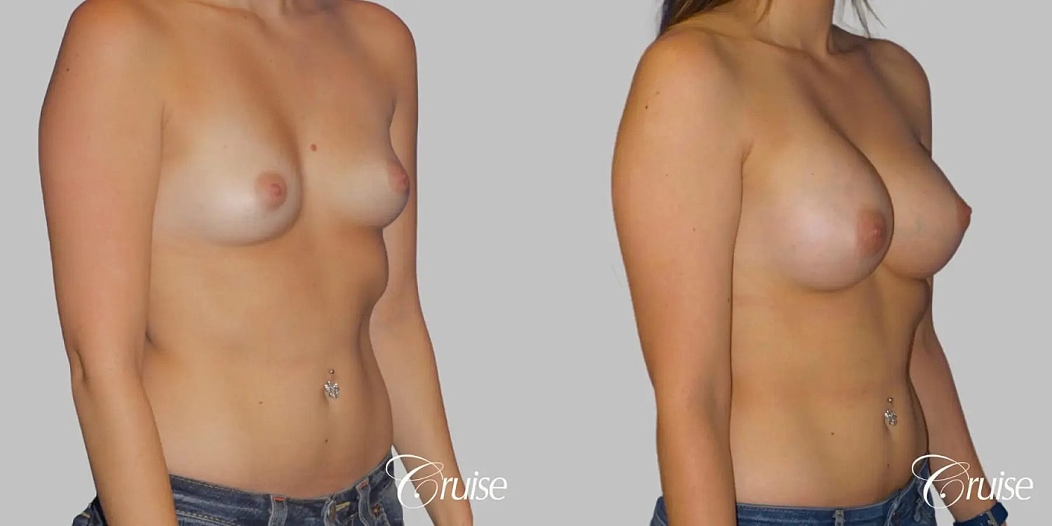 Breast Augmentation Before & After
