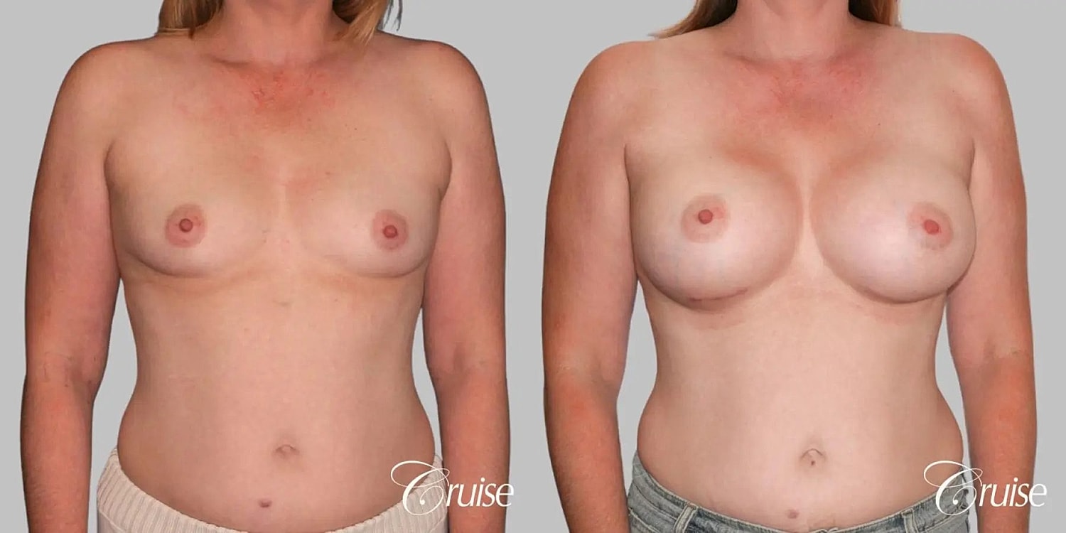 Breast Augmentation Before & After