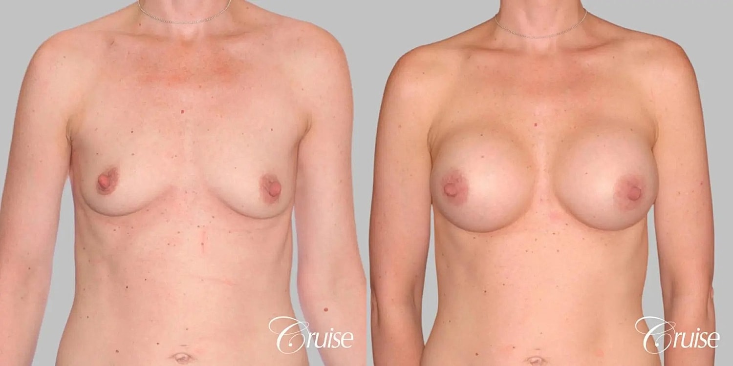 Breast Augmentation Before & After
