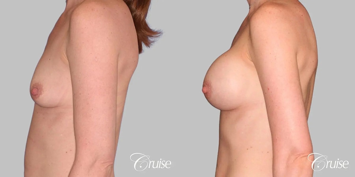 Breast Augmentation Before & After