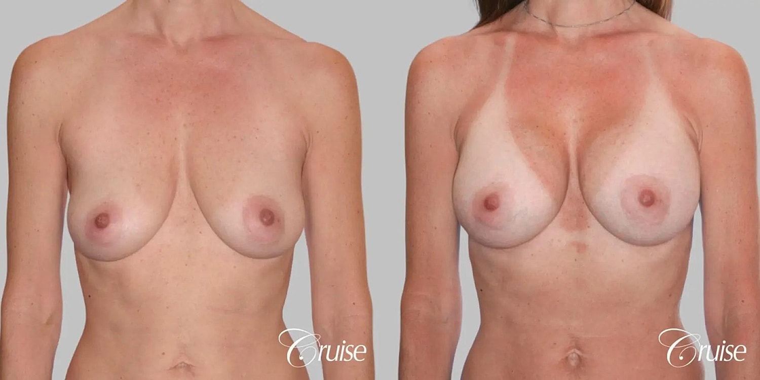 Breast Augmentation Before & After