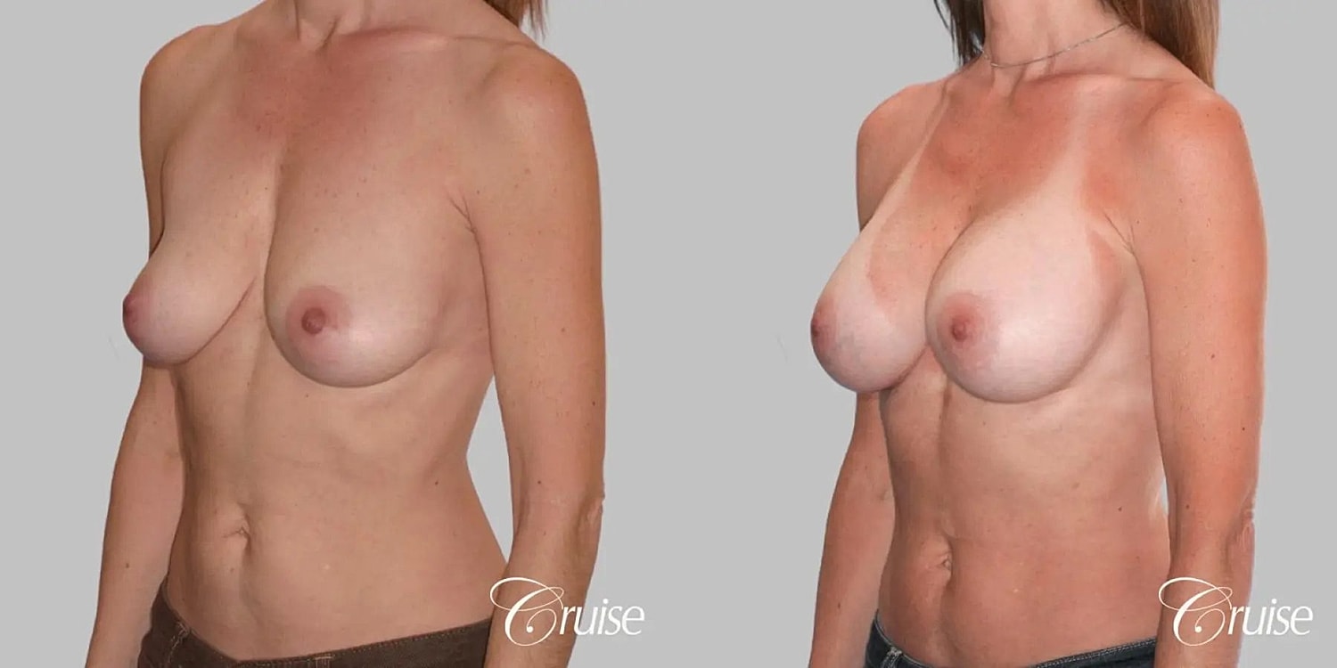 Breast Augmentation Before & After