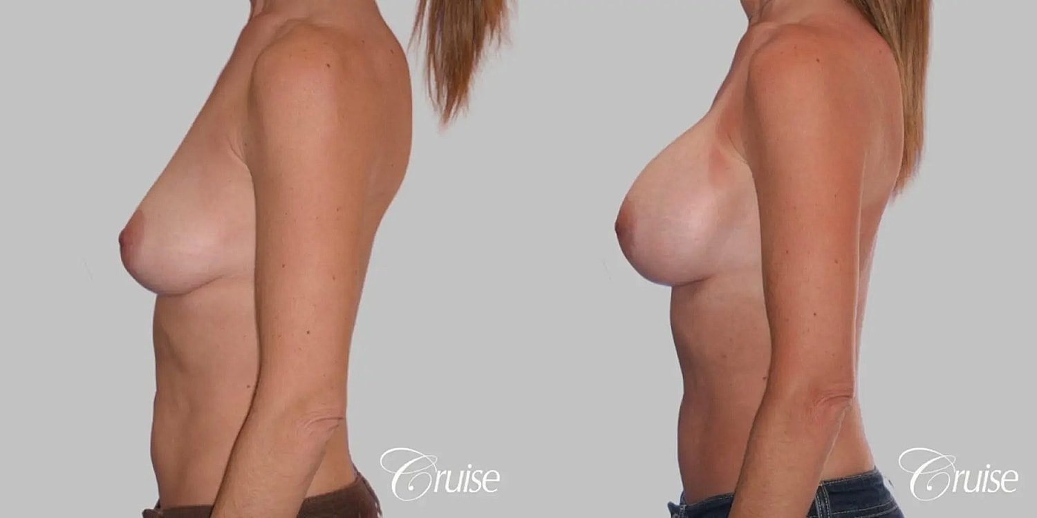 Breast Augmentation Before & After