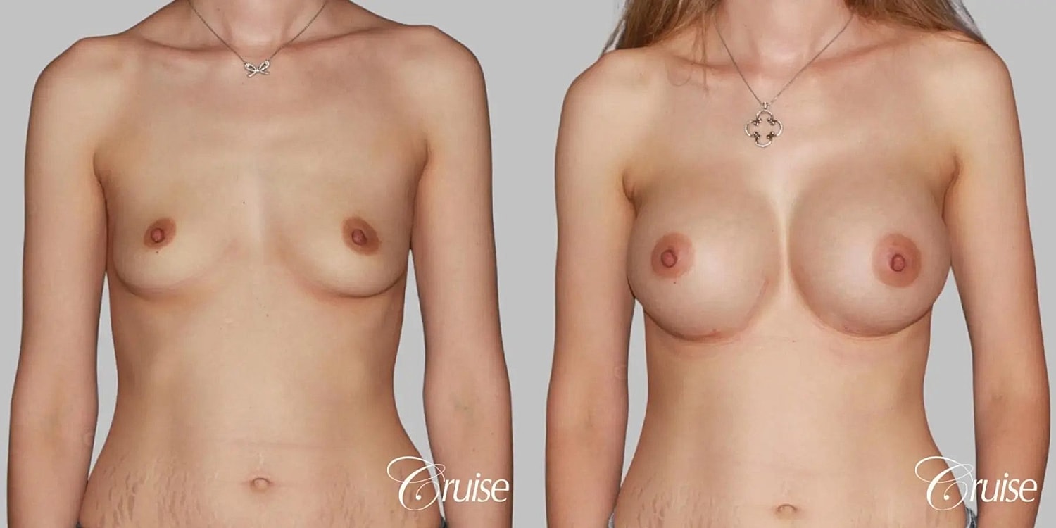 Breast Augmentation Before & After