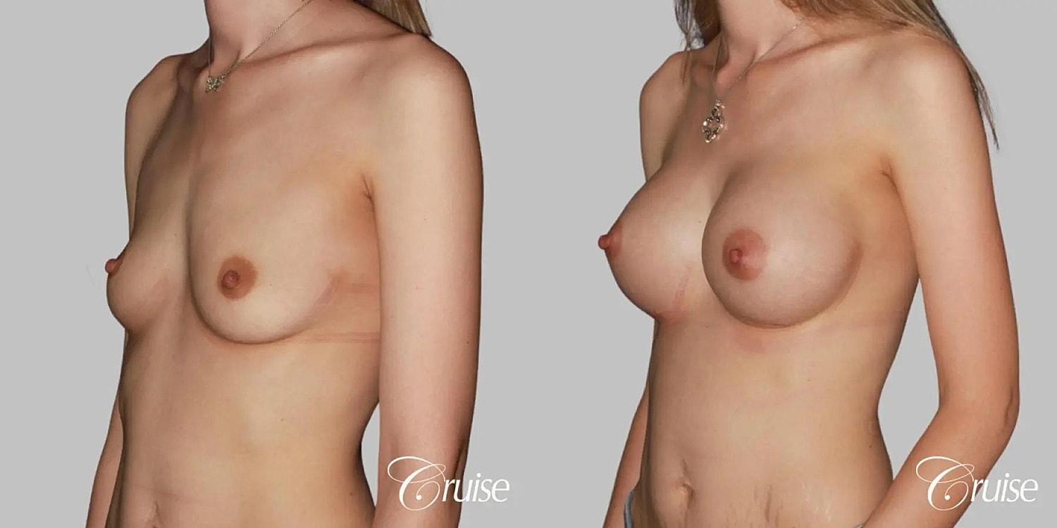 Breast Augmentation Before & After
