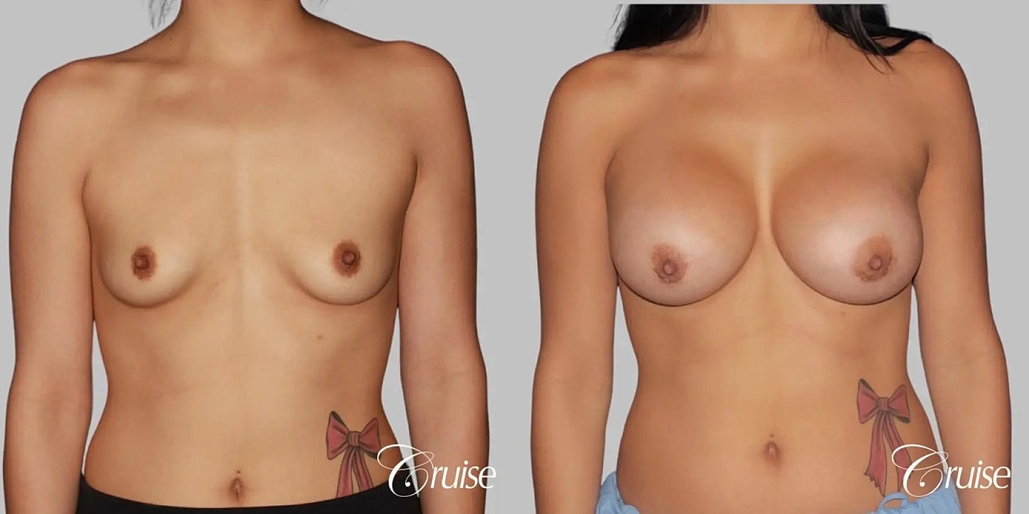 Breast Augmentation Before & After