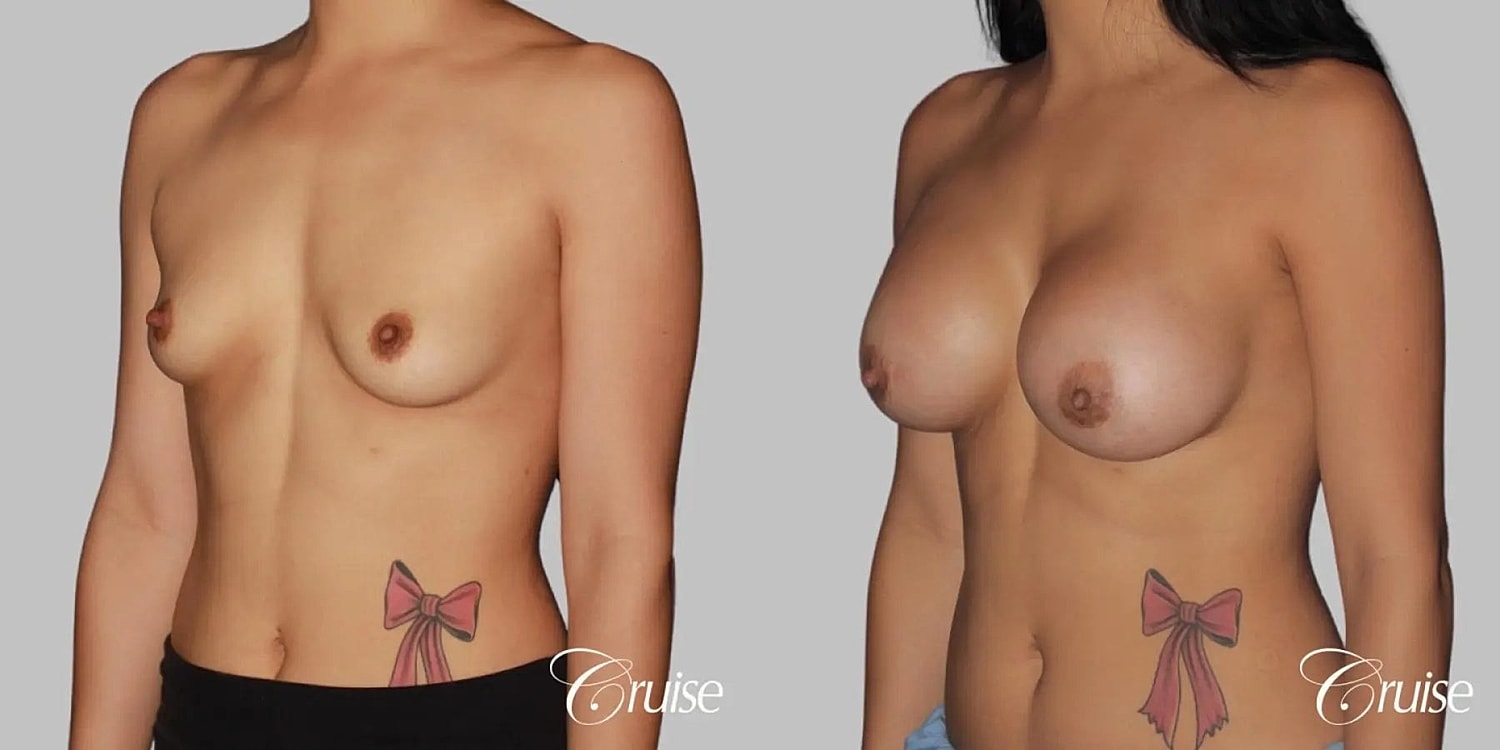 Breast Augmentation Before & After