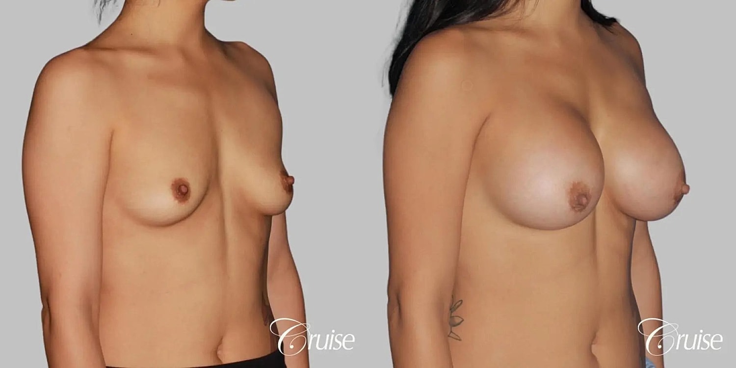 Breast Augmentation Before & After
