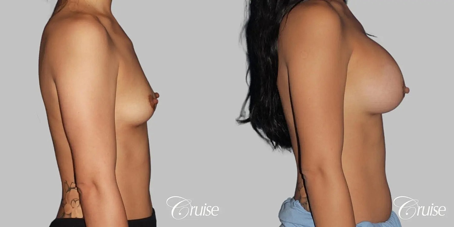Breast Augmentation Before & After