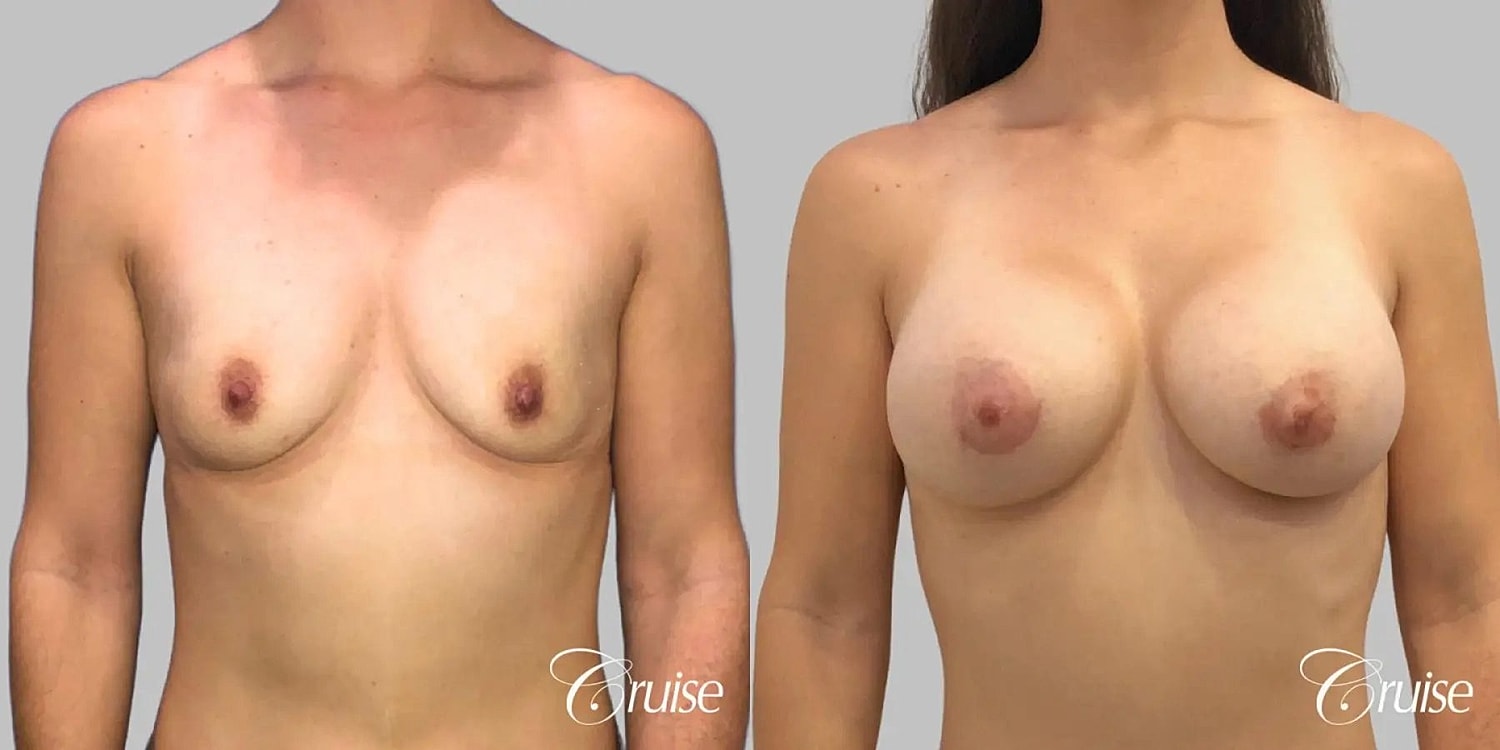 Breast Augmentation Before & After