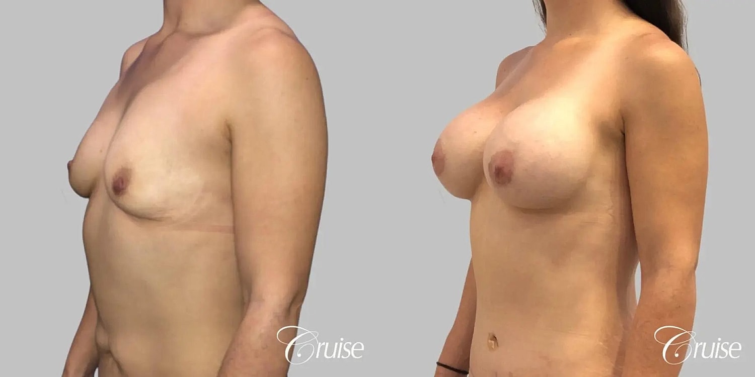 Breast Augmentation Before & After