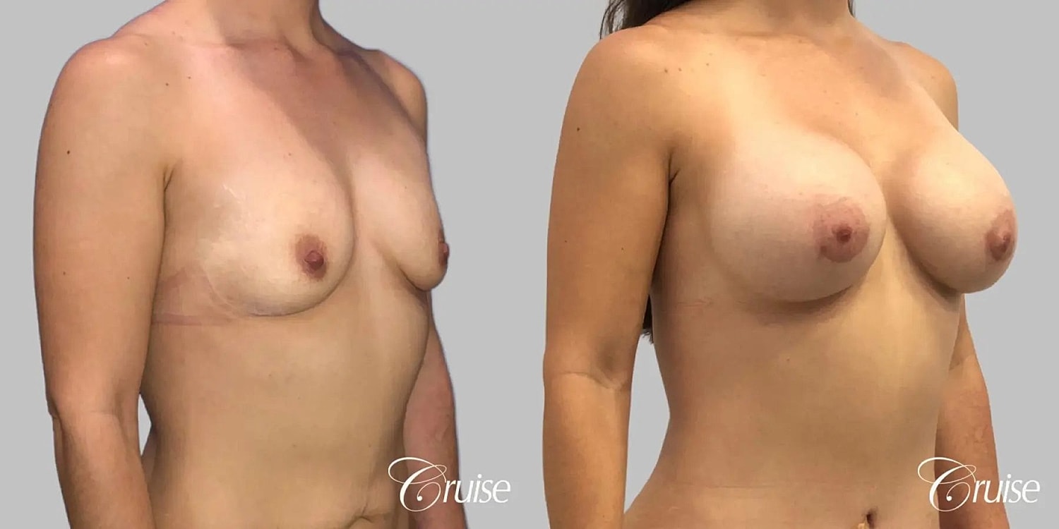 Breast Augmentation Before & After