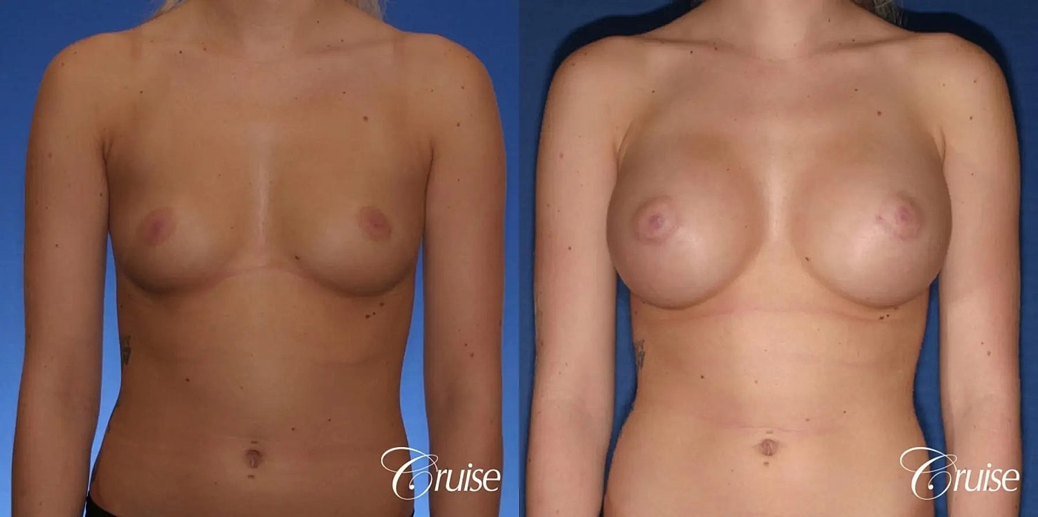 Breast Augmentation Before & After