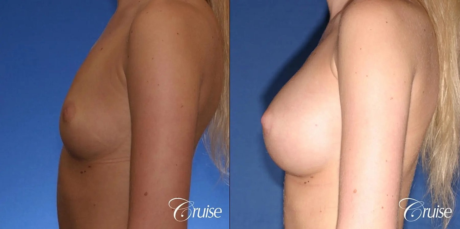 Breast Augmentation Before & After