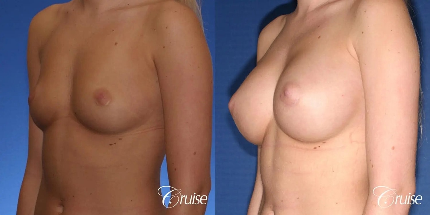 Breast Augmentation Before & After
