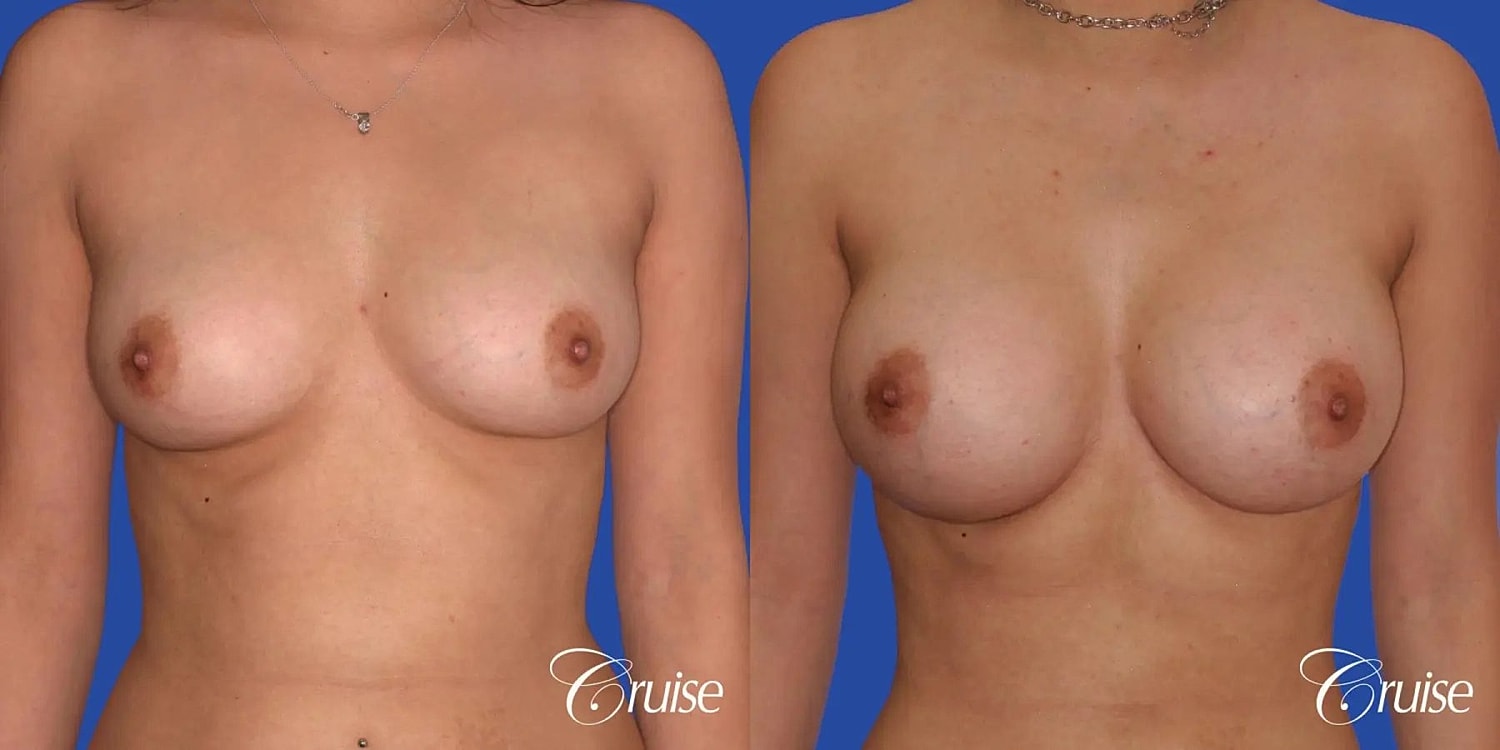 Breast Augmentation Before & After