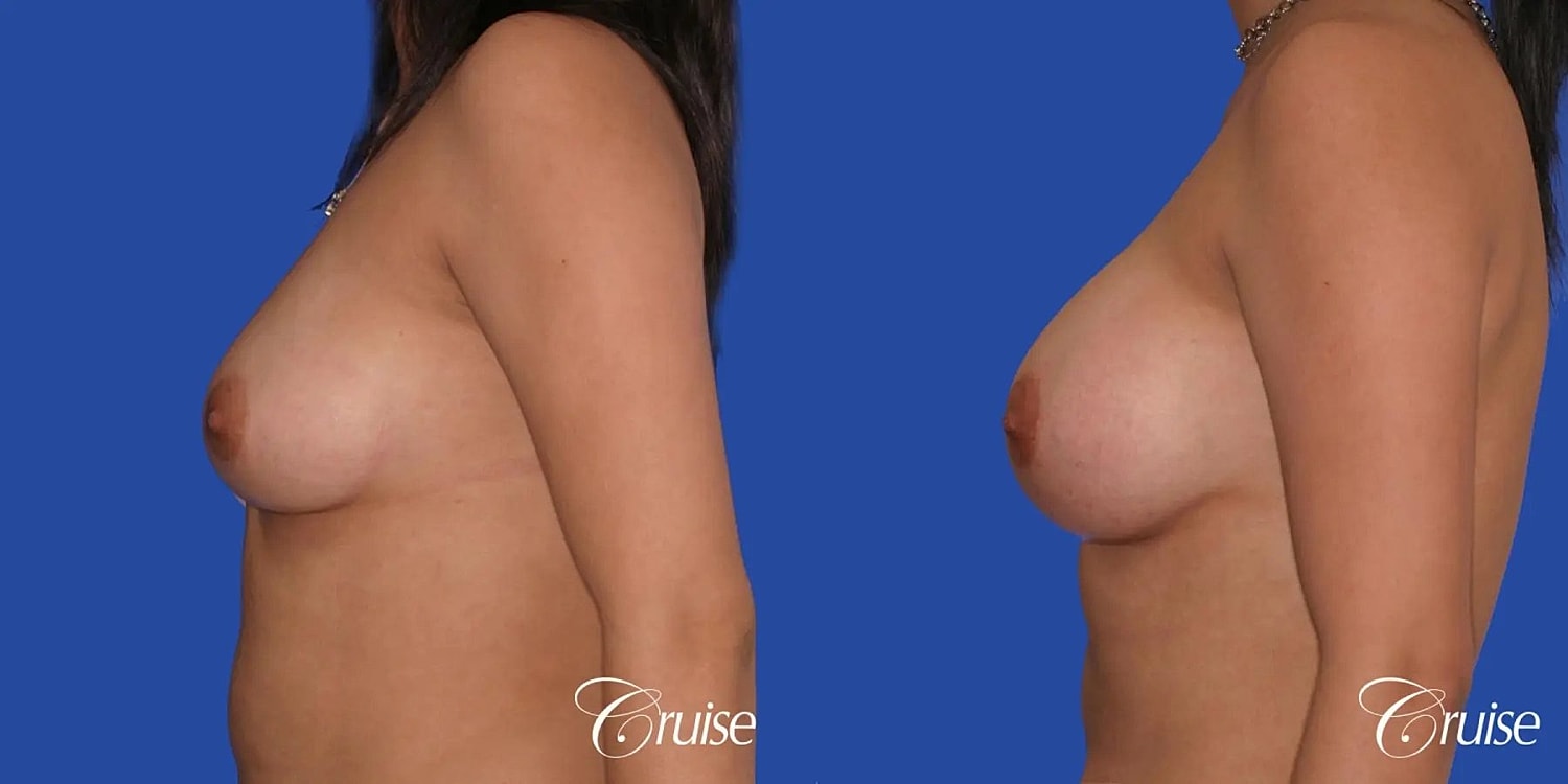 Breast Augmentation Before & After