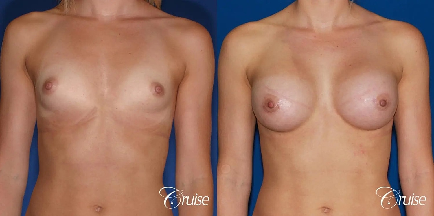Breast Augmentation Before & After