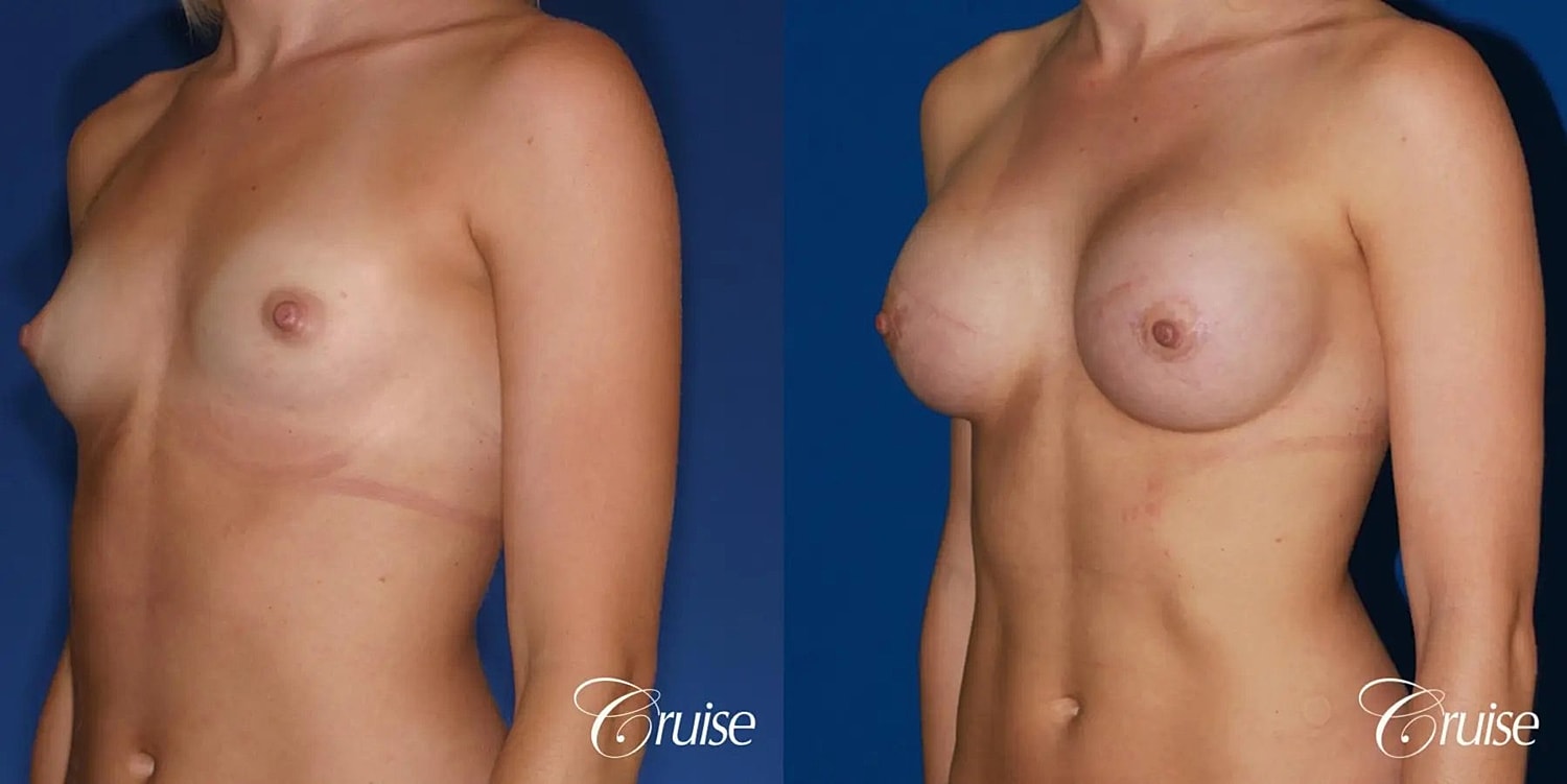 Breast Augmentation Before & After
