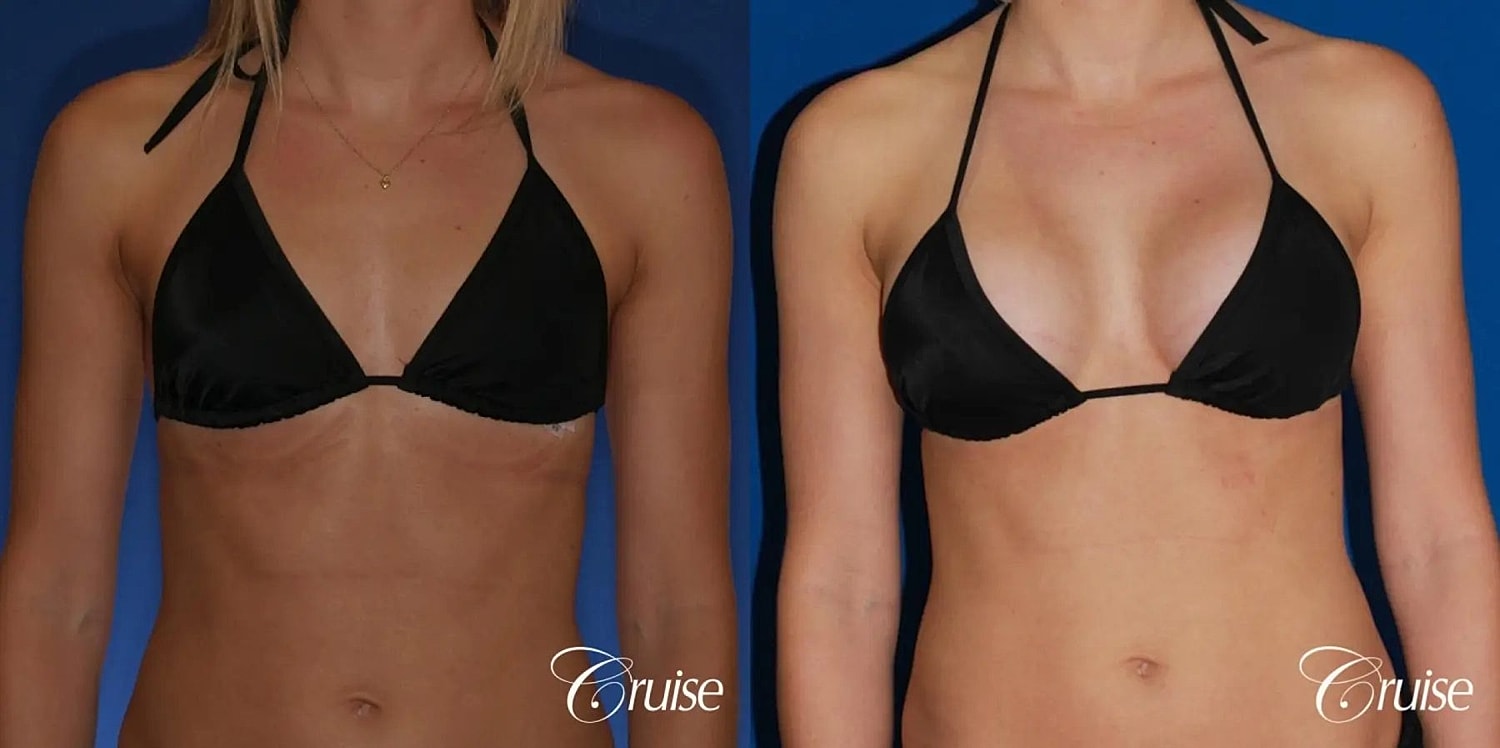 Breast Augmentation Before & After