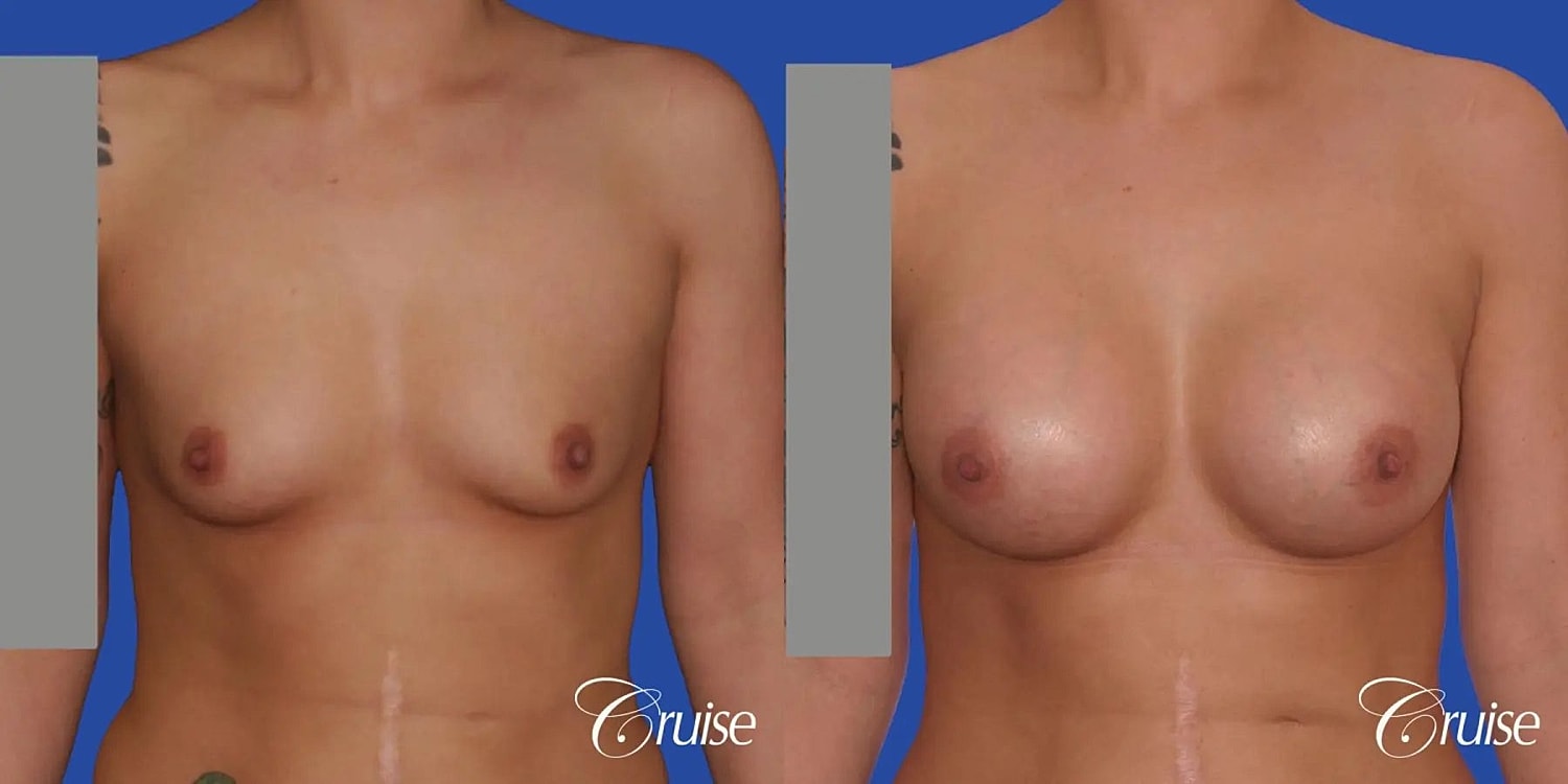 Breast Augmentation Before & After