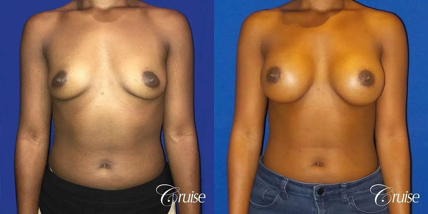 Breast Augmentation Before & After