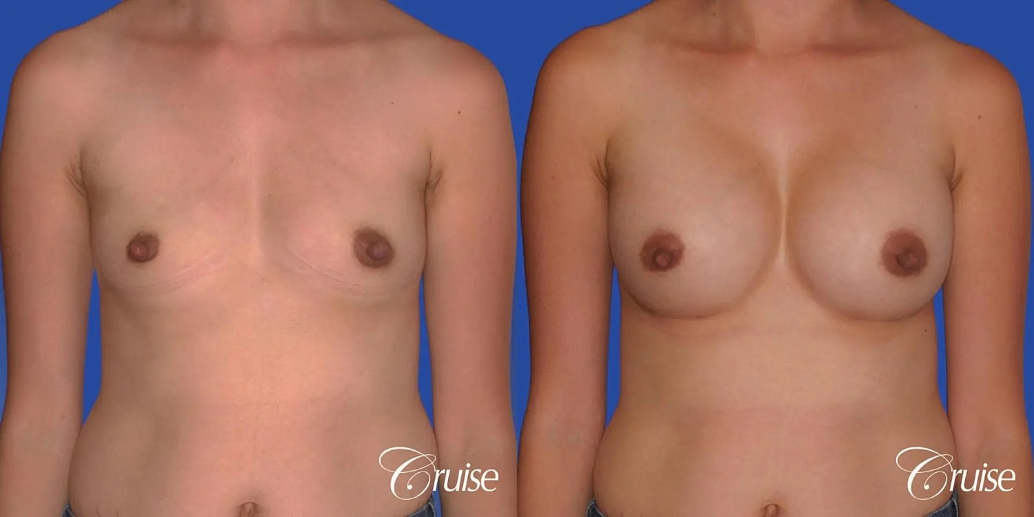 Breast Augmentation Before & After