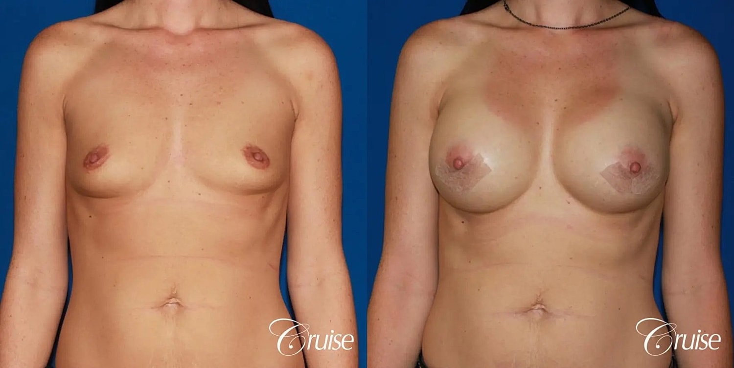 Breast Augmentation Before & After