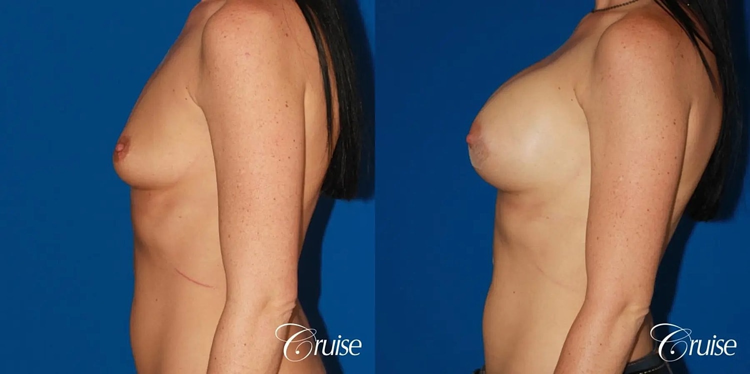 Breast Augmentation Before & After