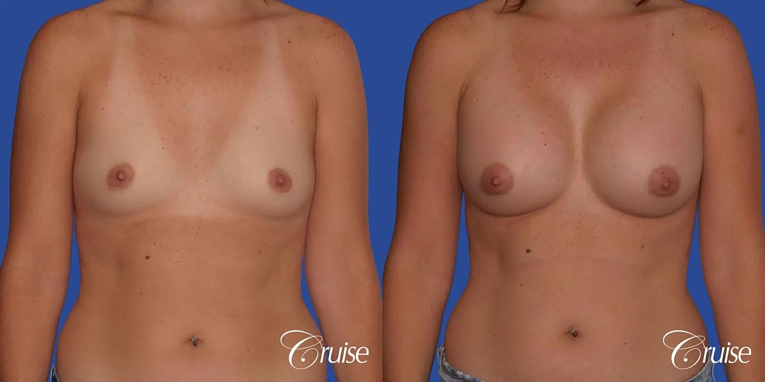 Breast Augmentation Before & After