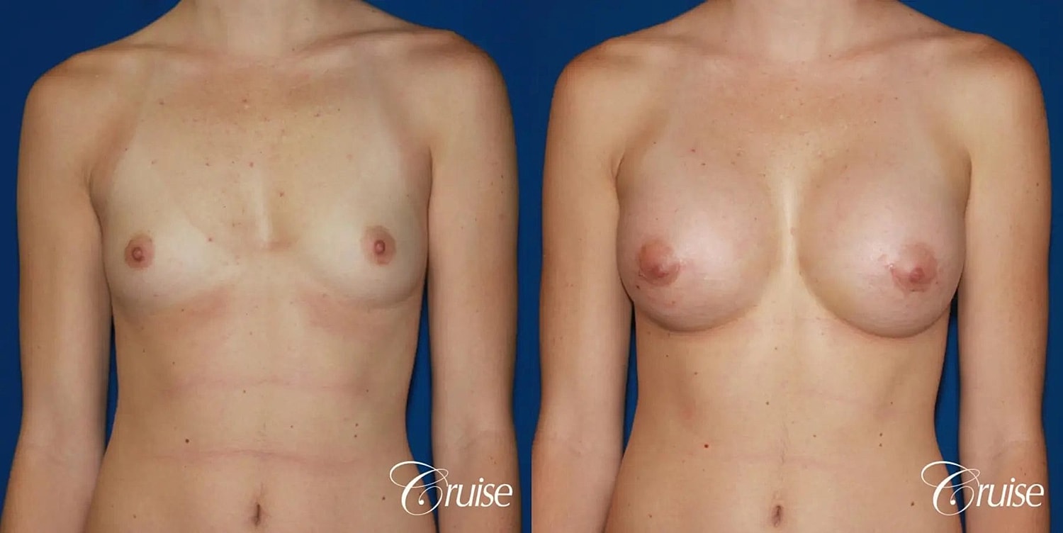 Breast Augmentation Before & After