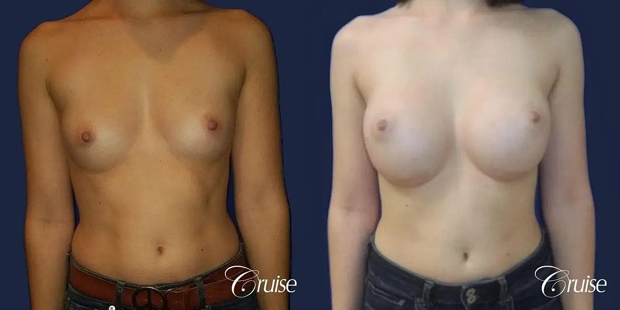 Breast Augmentation Before & After
