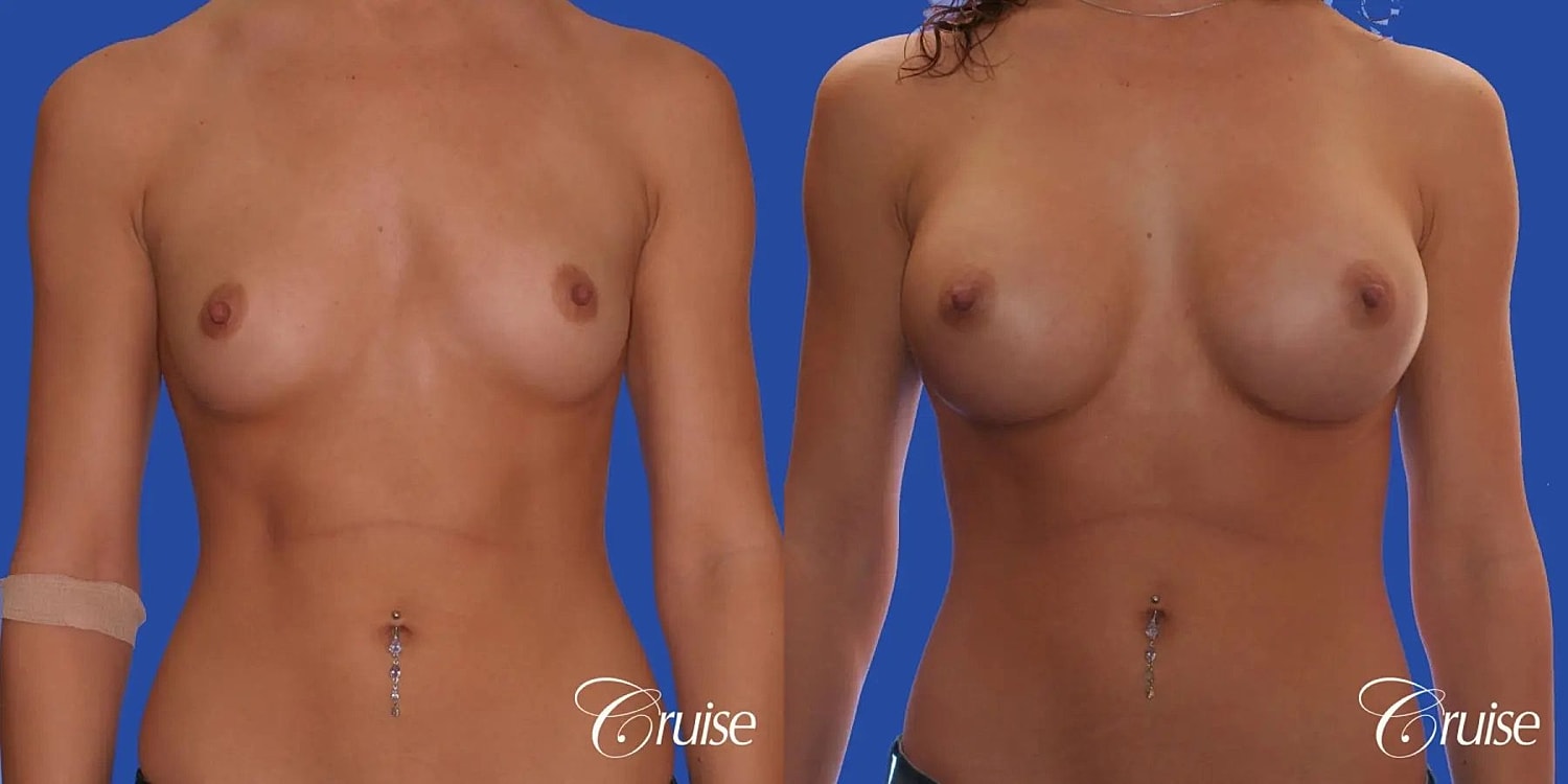 Breast Augmentation Before & After