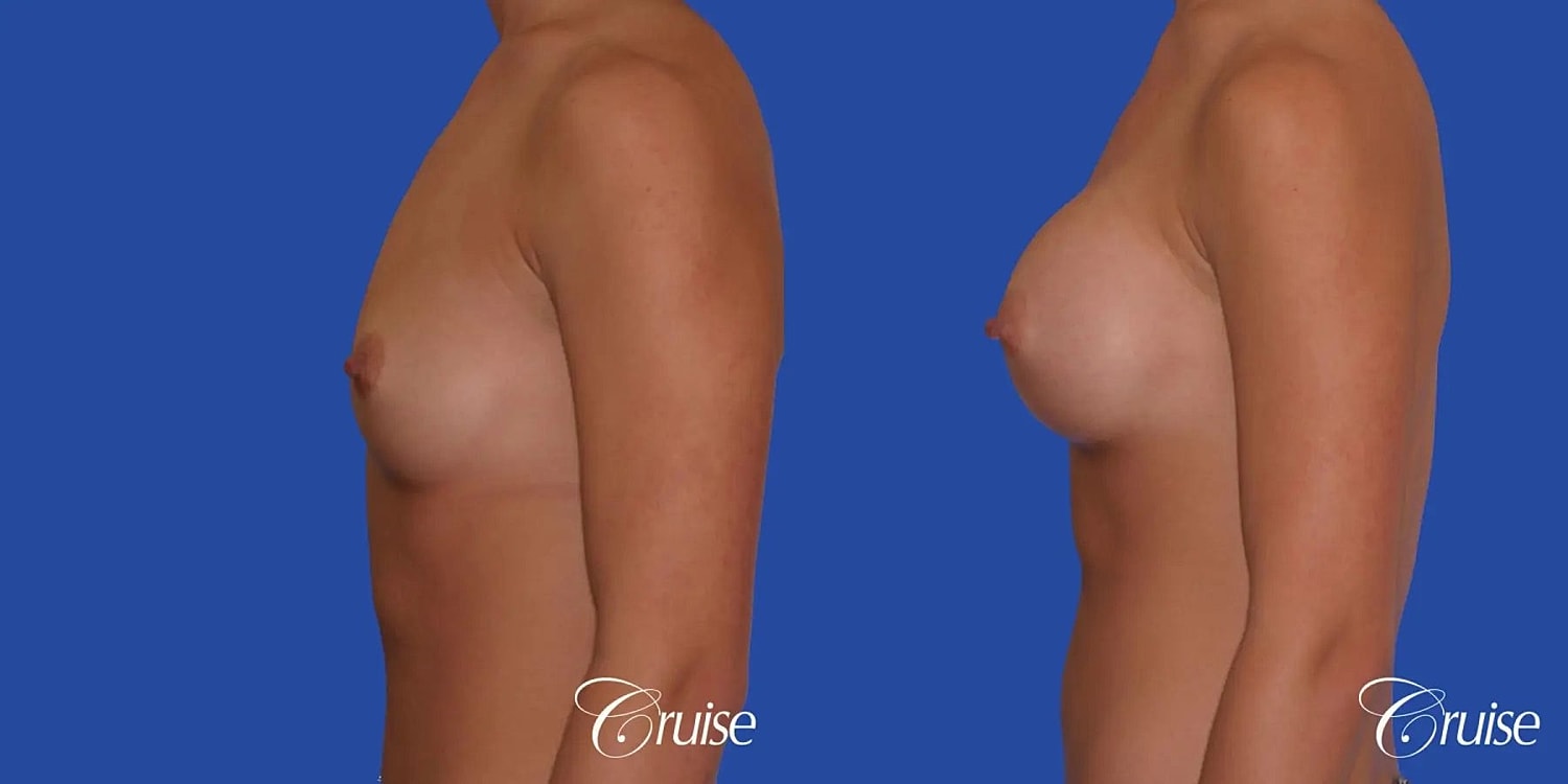 Breast Augmentation Before & After