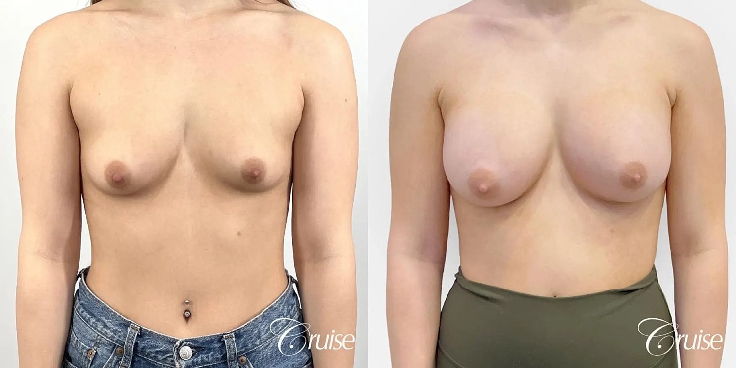 Breast Augmentation Before & After