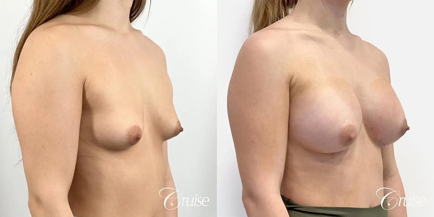 Breast Augmentation Before & After