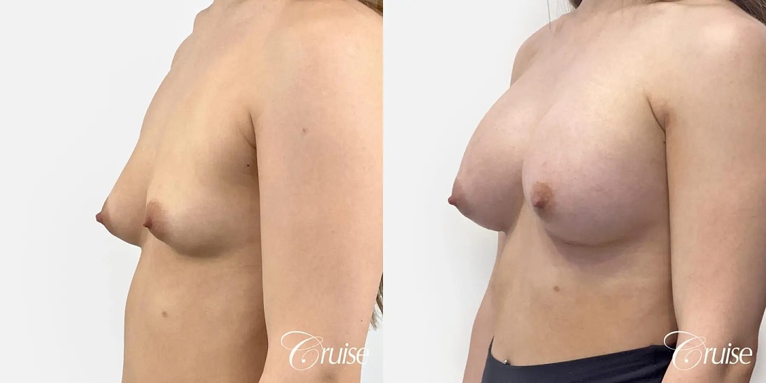 Breast Augmentation Before & After