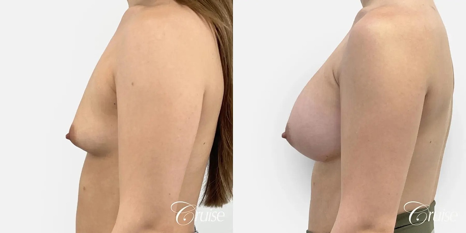 Breast Augmentation Before & After