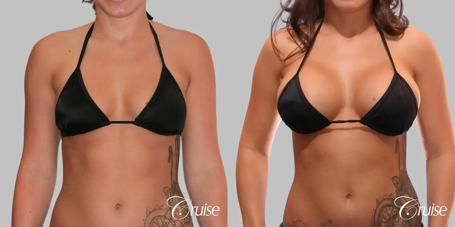Breast Augmentation  Before & After
