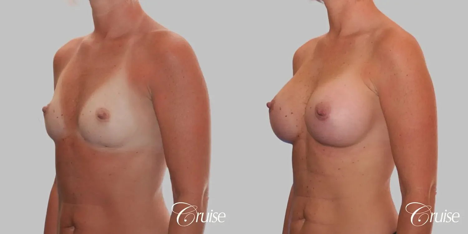 Breast Augmentation  Before & After
