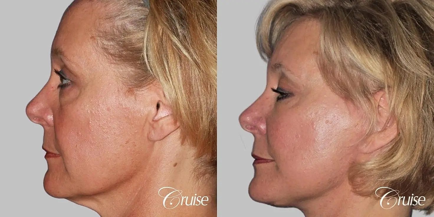 Facial Fat Transfer Before & After