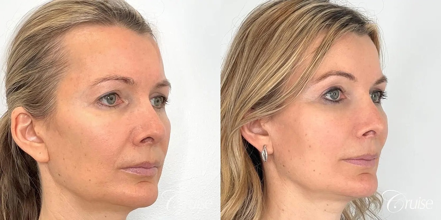 Facial Fat Transfer Before & After