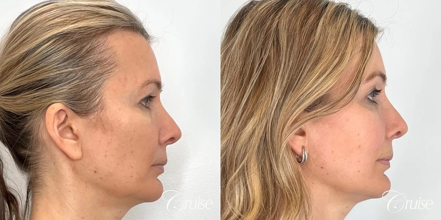Facial Fat Transfer Before & After