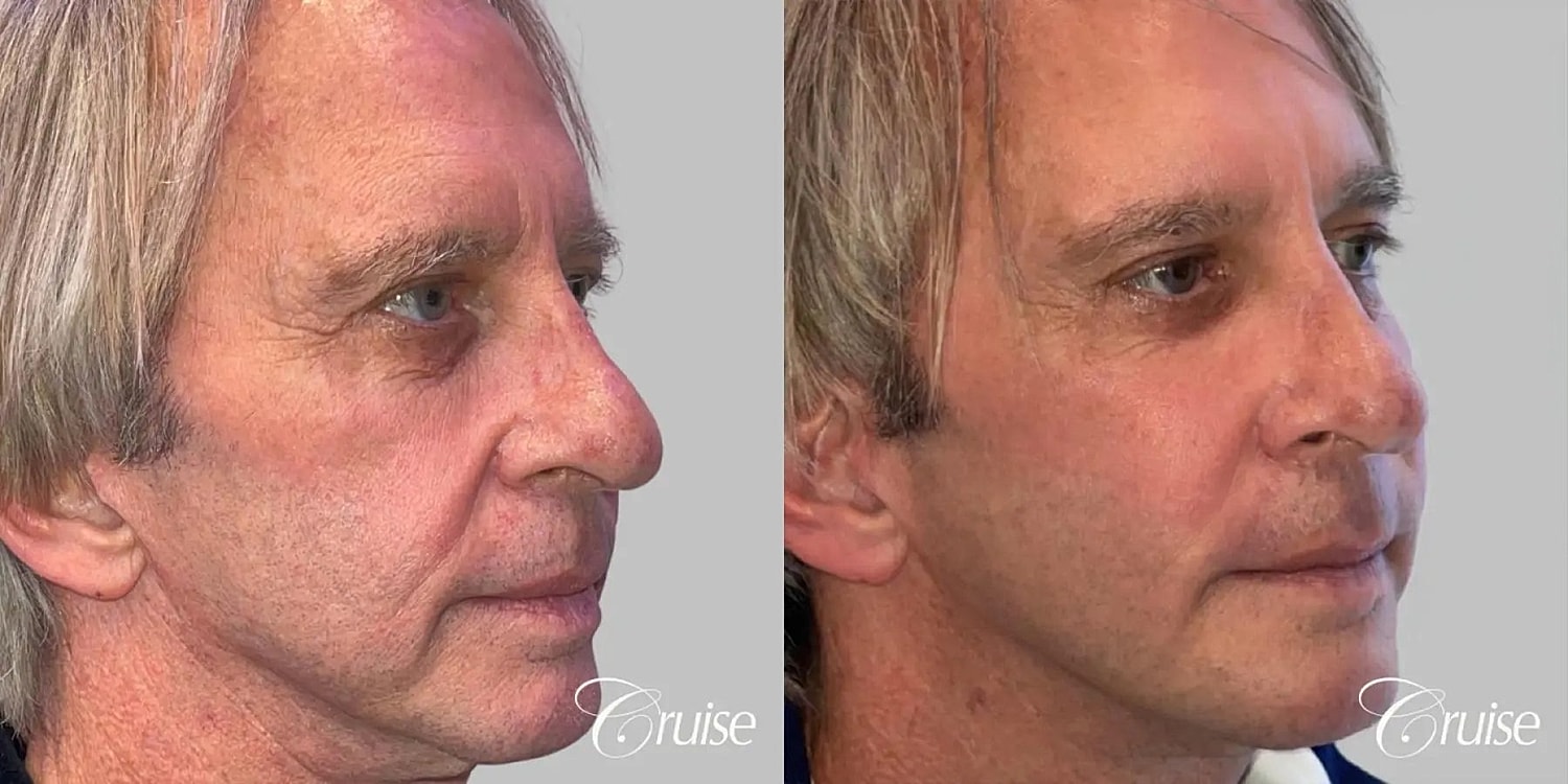 Facial Fat Transfer Before & After