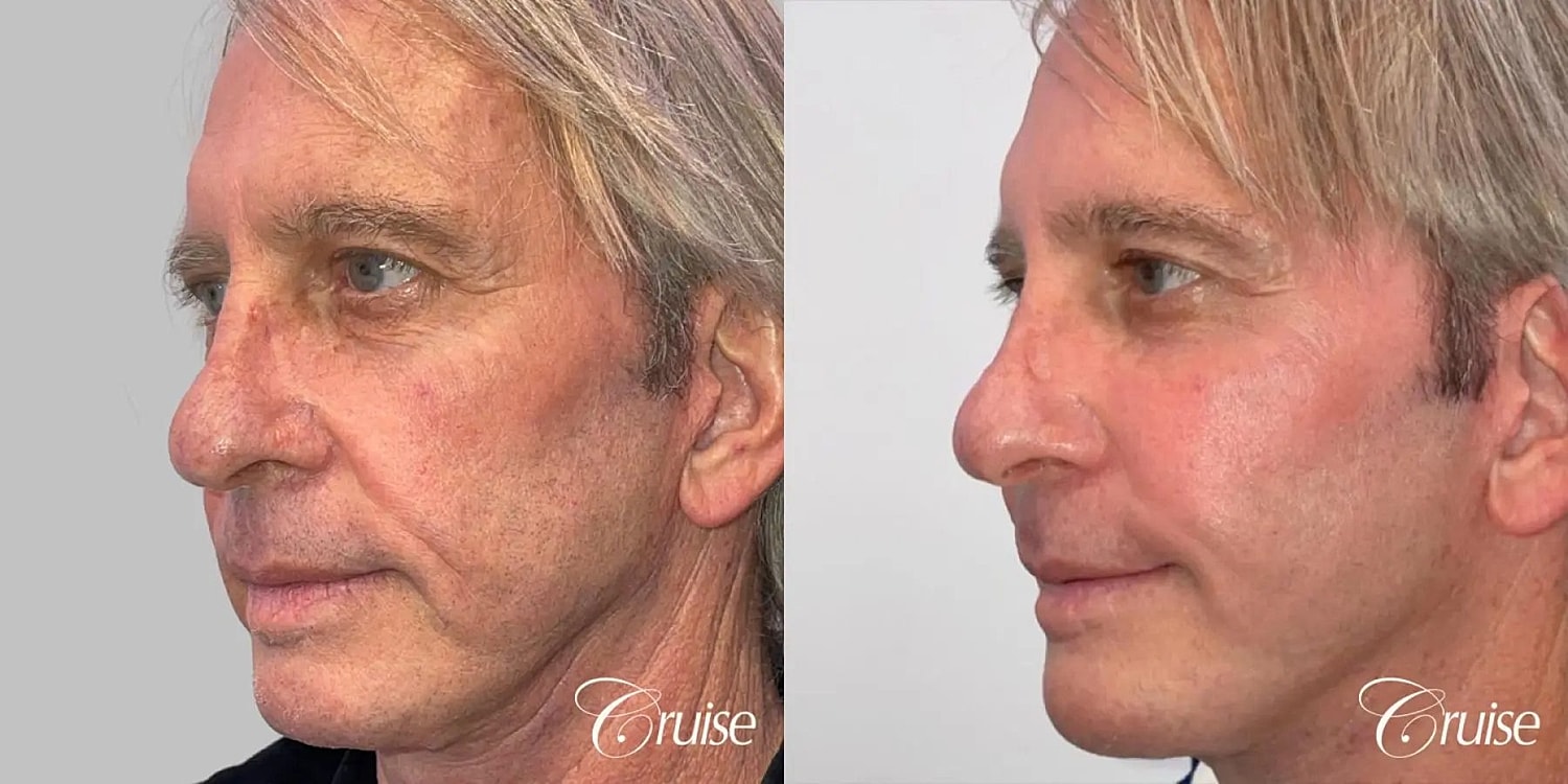 Facial Fat Transfer Before & After