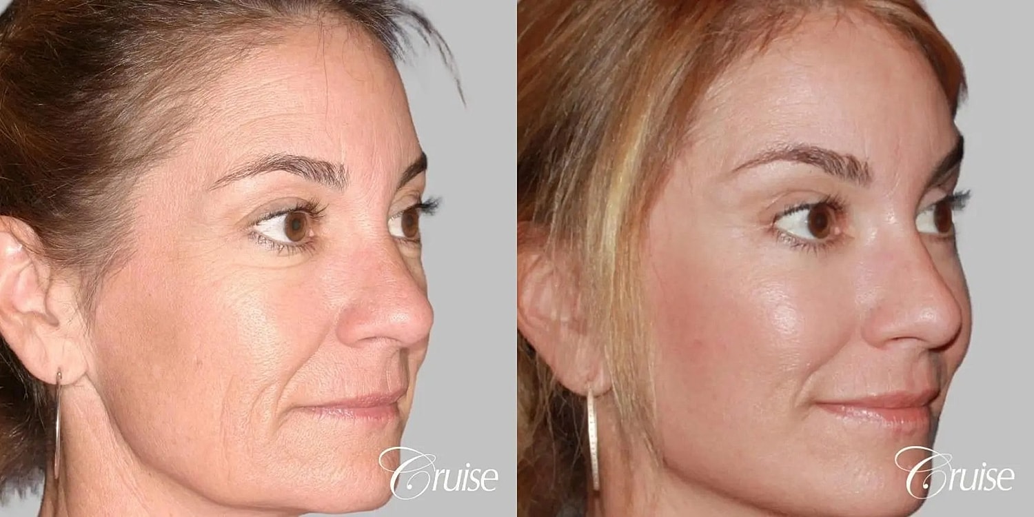 Facial Fat Transfer Before & After